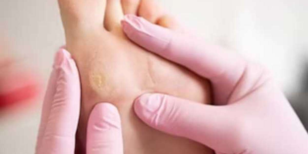 Foot Corn Removal Singapore: Best Solutions for Pain-Free Walking