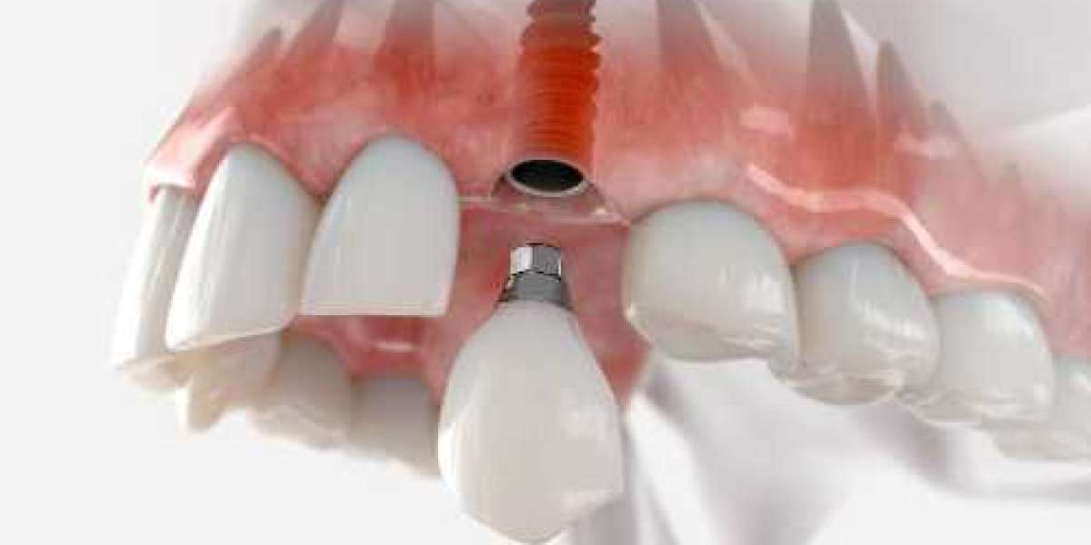 Dental Implants Oxnard: A Complete Guide to Restoring Your Smile