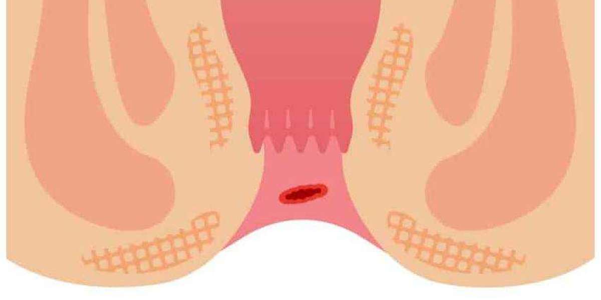 Best Treatment for Piles (Hemorrhoids)