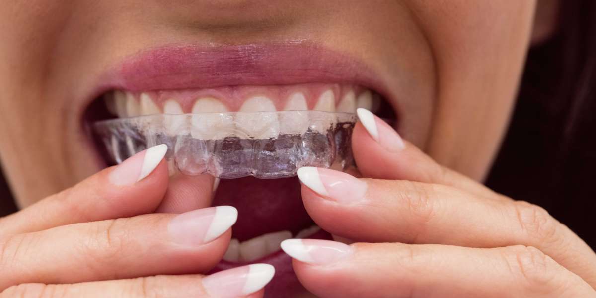How Does a Night Mouthguard Work to Prevent Teeth Grinding?