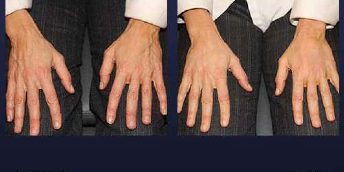 CO2 Hand Rejuvenation: Say Goodbye to Wrinkled Hands